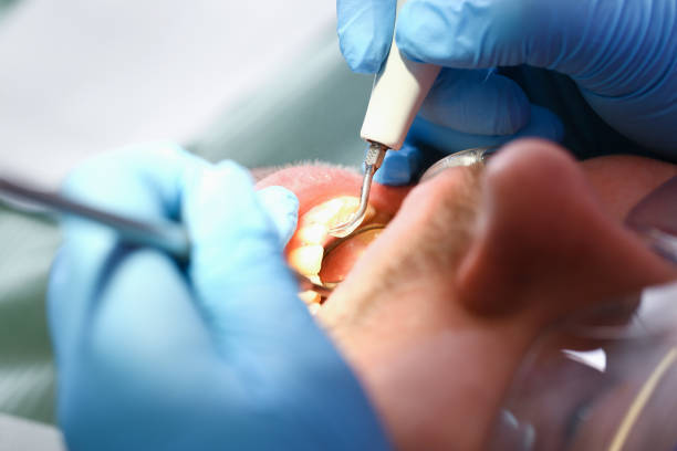 Best Emergency Wisdom Tooth Extraction in Lawrenceville, VA
