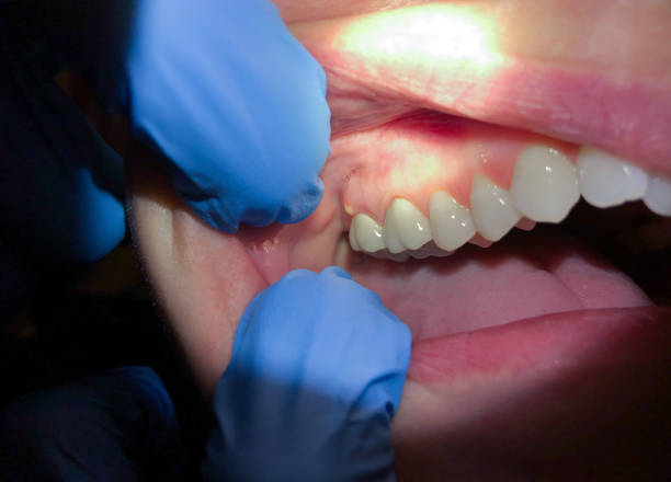 Best Knocked-Out Tooth (Avulsed Tooth) Treatment in Lawrenceville, VA
